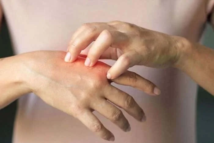 Chilblains (Pernio) are Common- Here is How to Manage this Skin Condition
