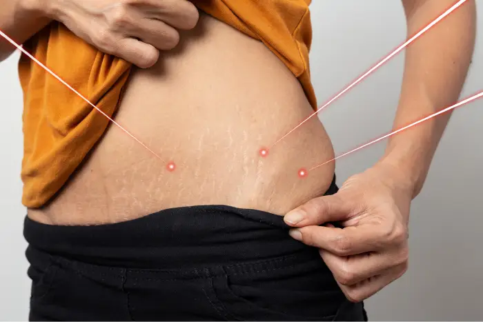 Laser Stretch Mark Removal Treatment: A Guide by a Dermatologist