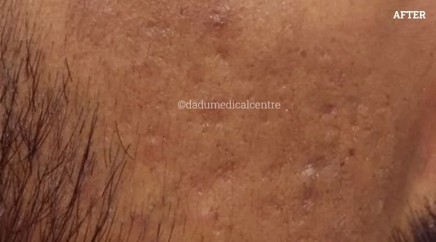 Chemical Burn After