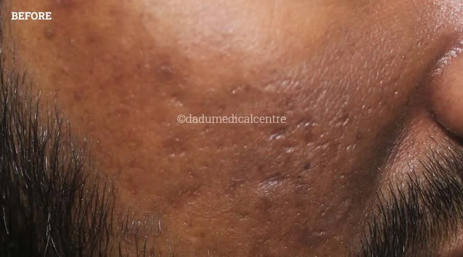 Chemical Burn Before