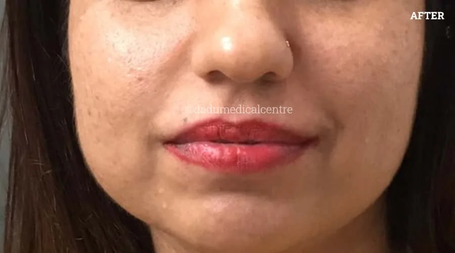Face-Lift After