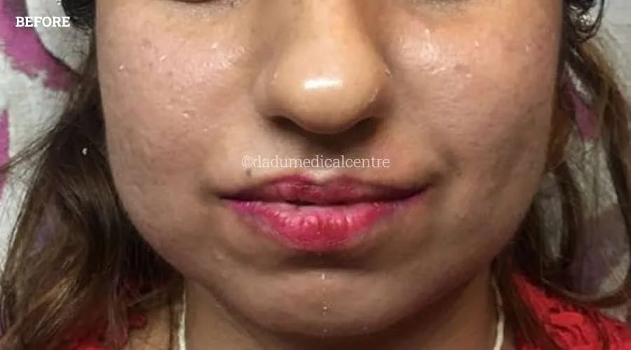 Face-Lift Before