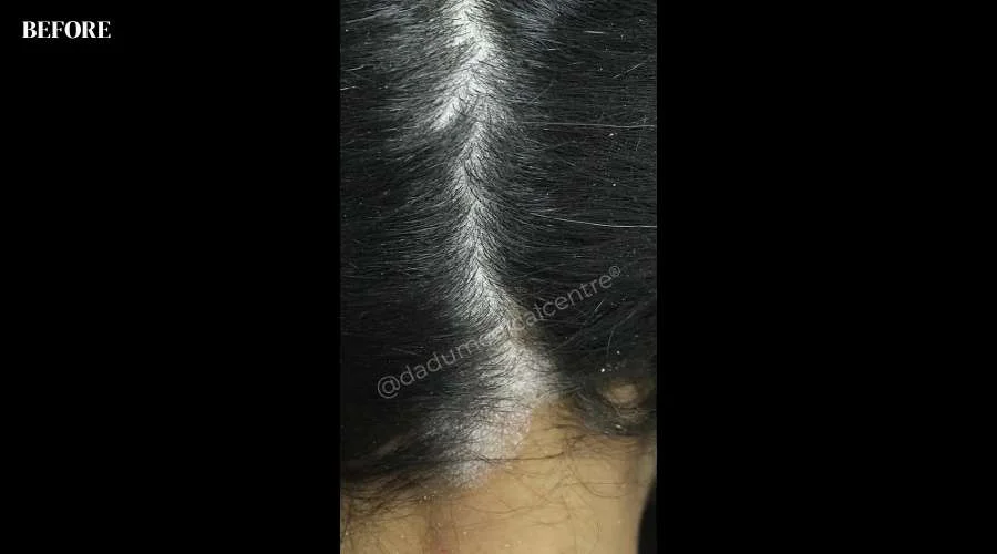 Dandruff Before