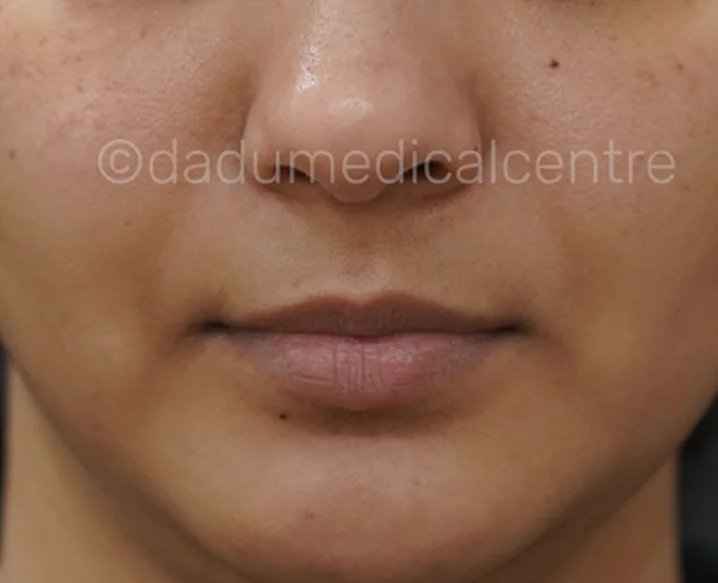 HydraFacial Lip Perk