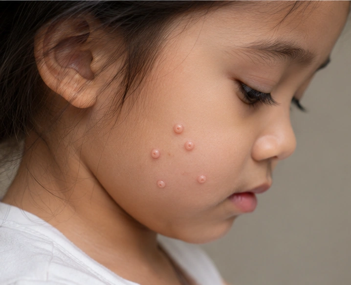 Molluscum Contagiosum