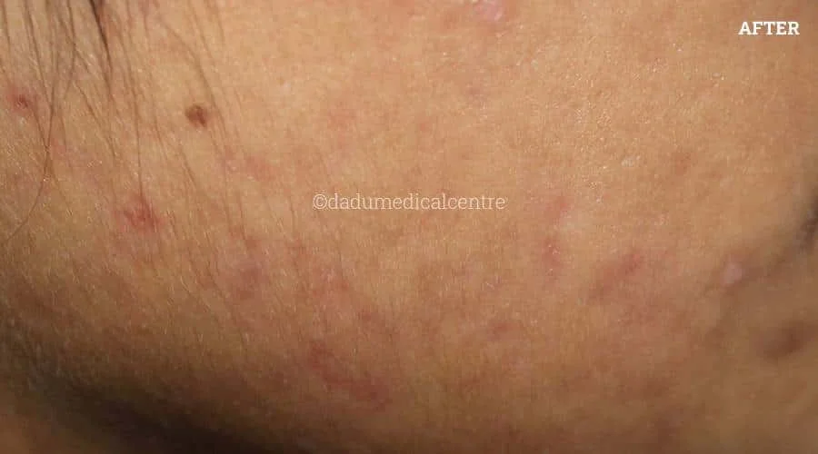Acne Check Peel - after
