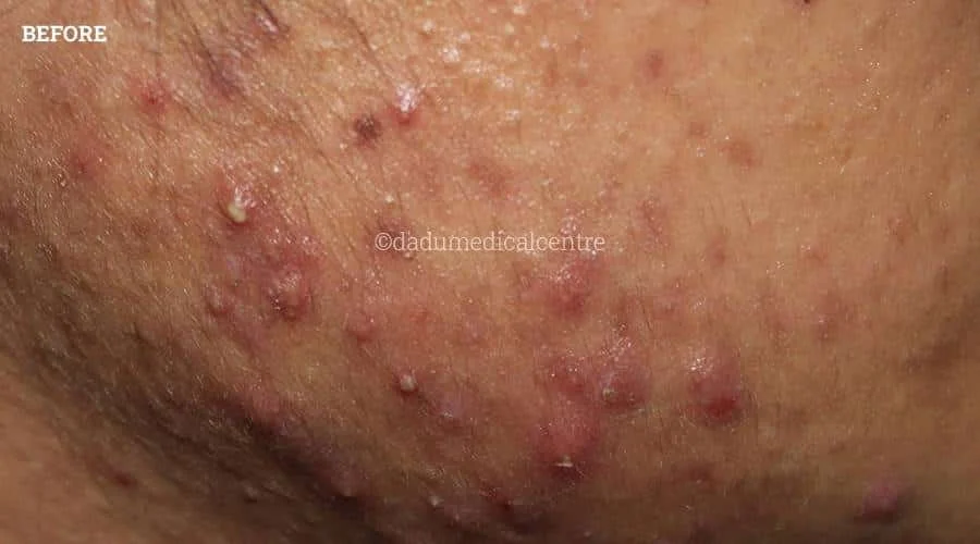 Acne Check Peel - before
