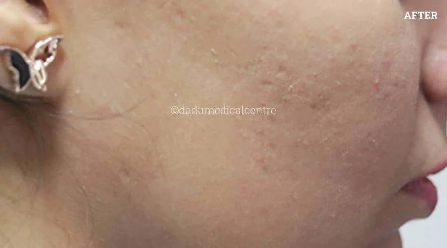 Acne Check Peel - after