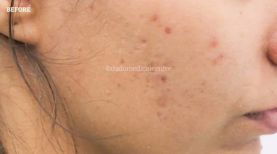 Acne Check Peel - before