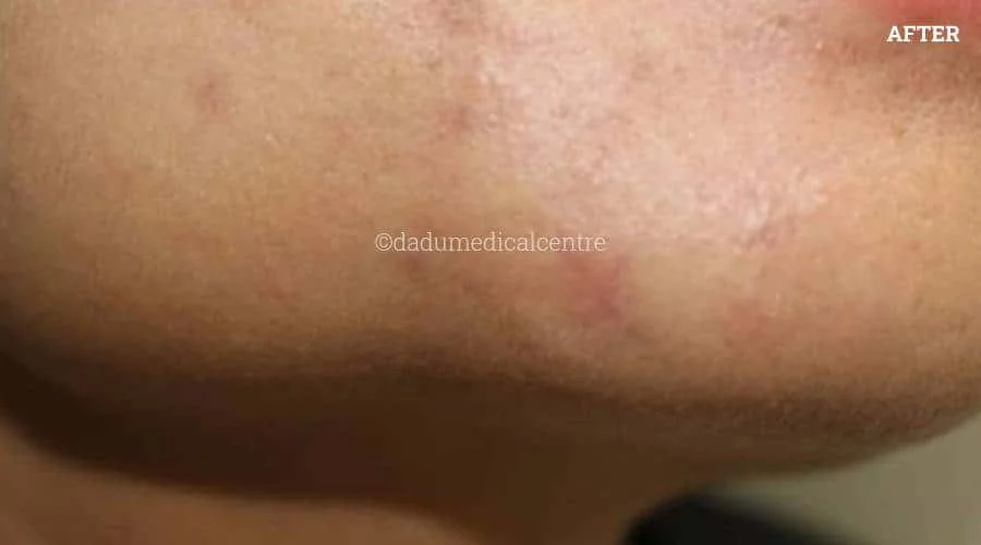 Acne ZAP - after