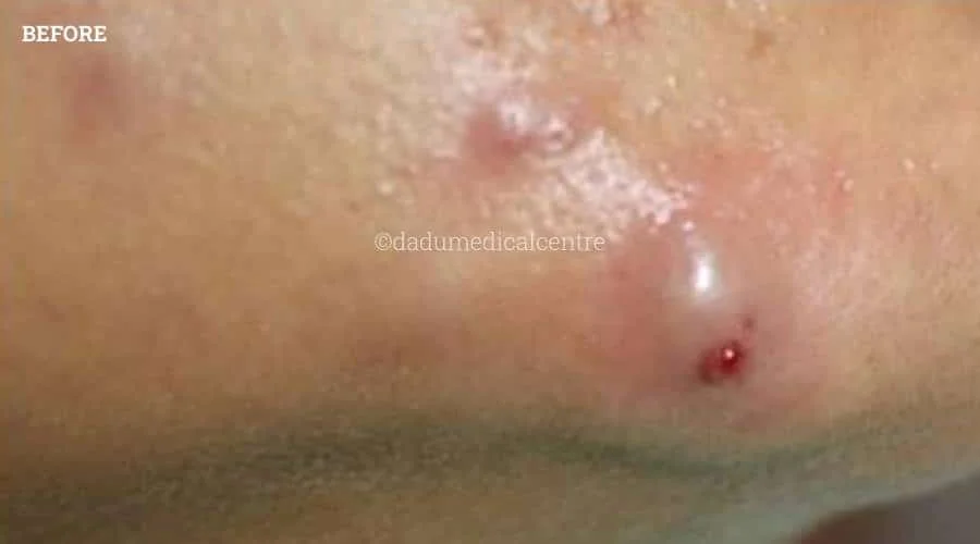 Acne ZAP - before