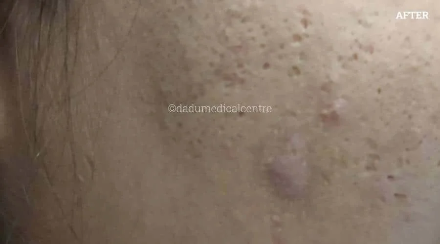 Acne ZAP - after