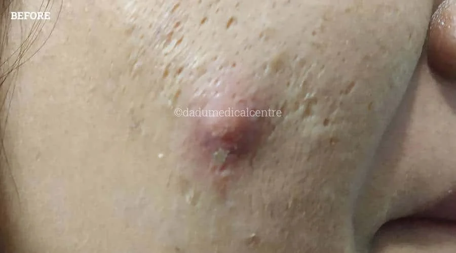 Acne ZAP - before