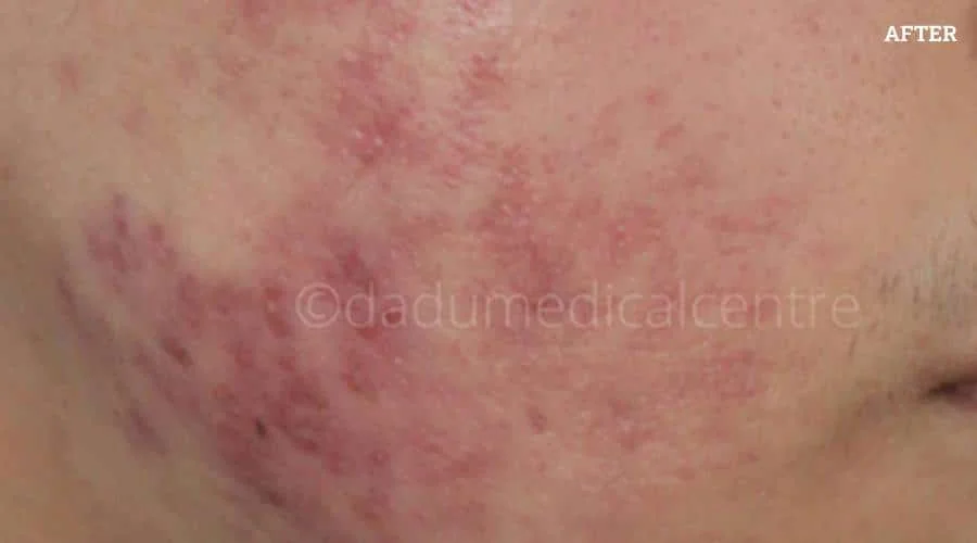 Acne Check Peel - after