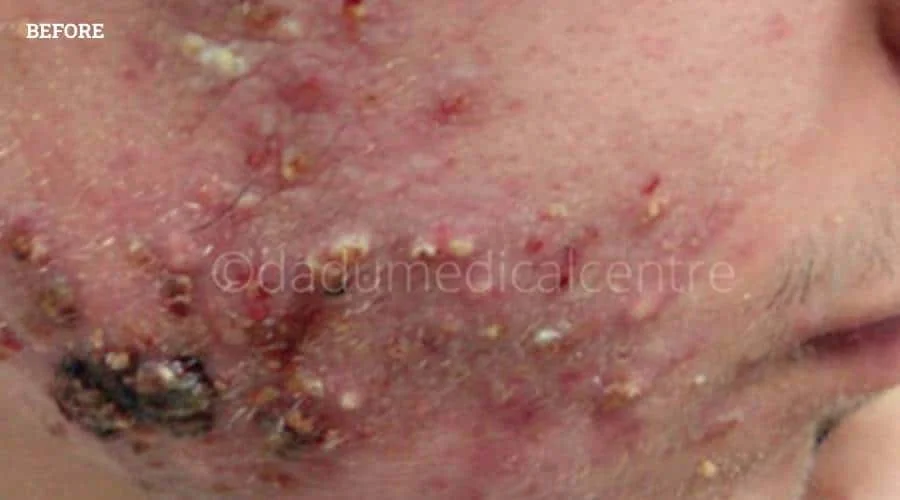 Acne Check Peel - before