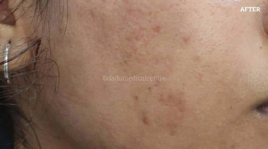 Acne Check Peel - after