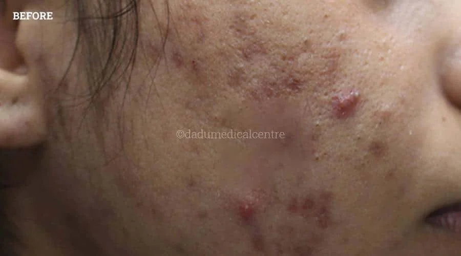 Acne Check Peel - before