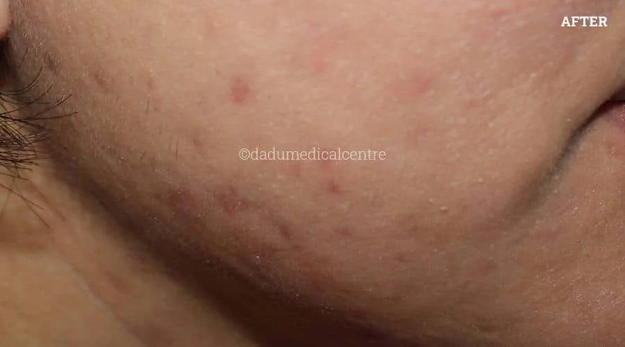 Acne Check Peel - after