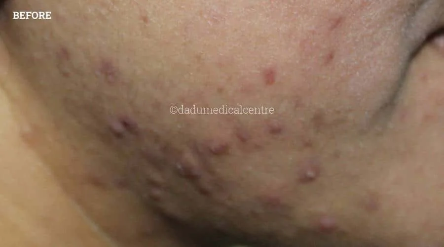 Acne Check Peel - before