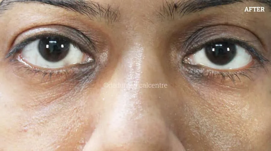 Dark Circles - after