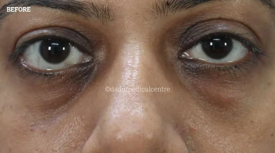 Dark Circles - before