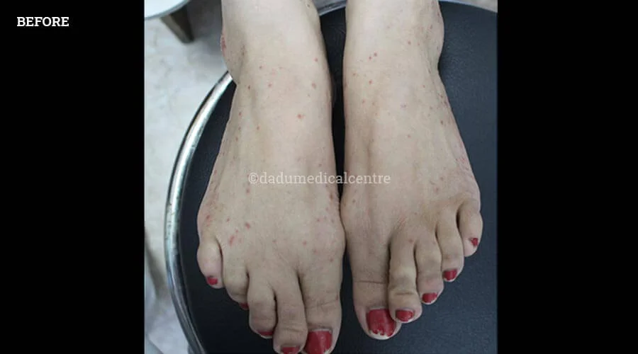 Psoriasis - before