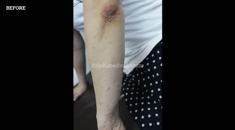 Psoriasis - before
