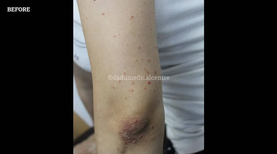 Psoriasis - before