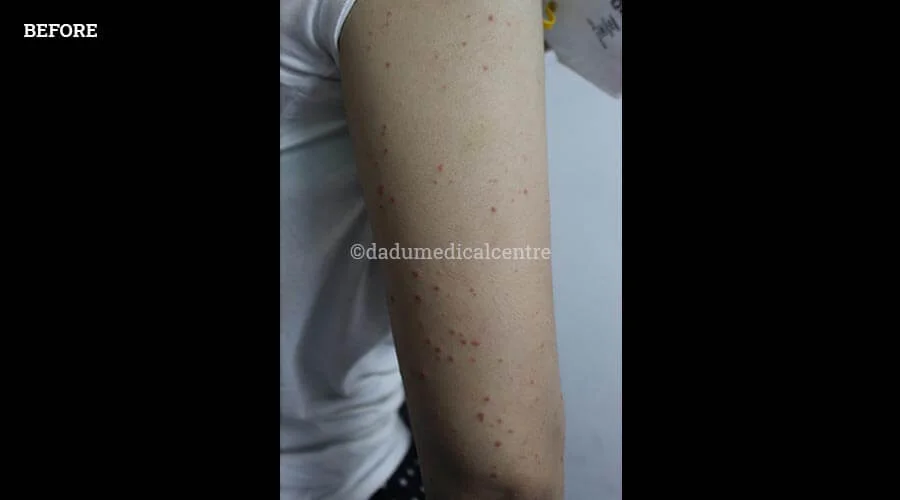 Psoriasis - before