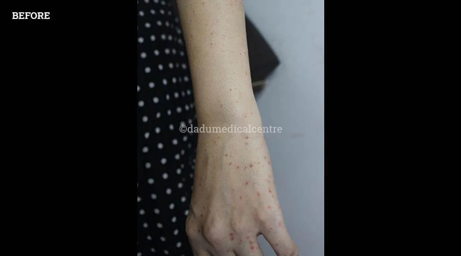 Psoriasis - before