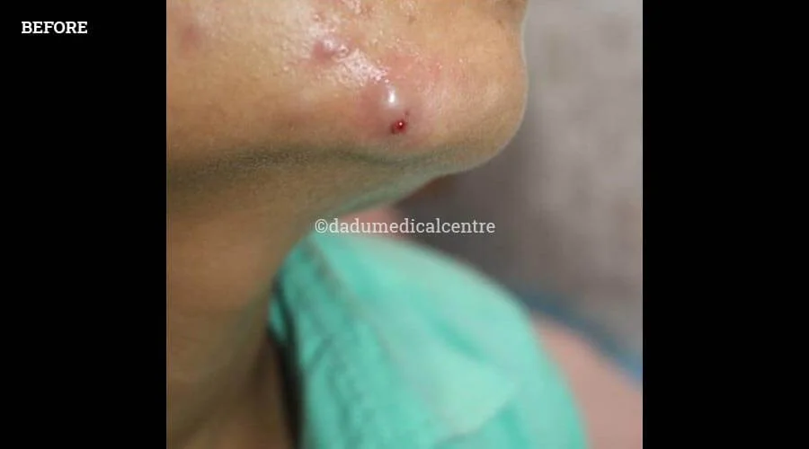 acne ZAP - before