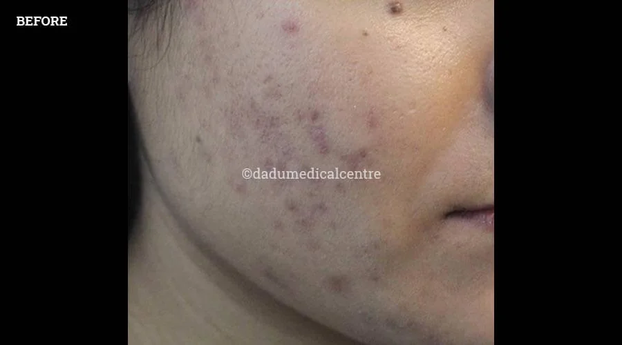 DMC-Acne Check Peel - before