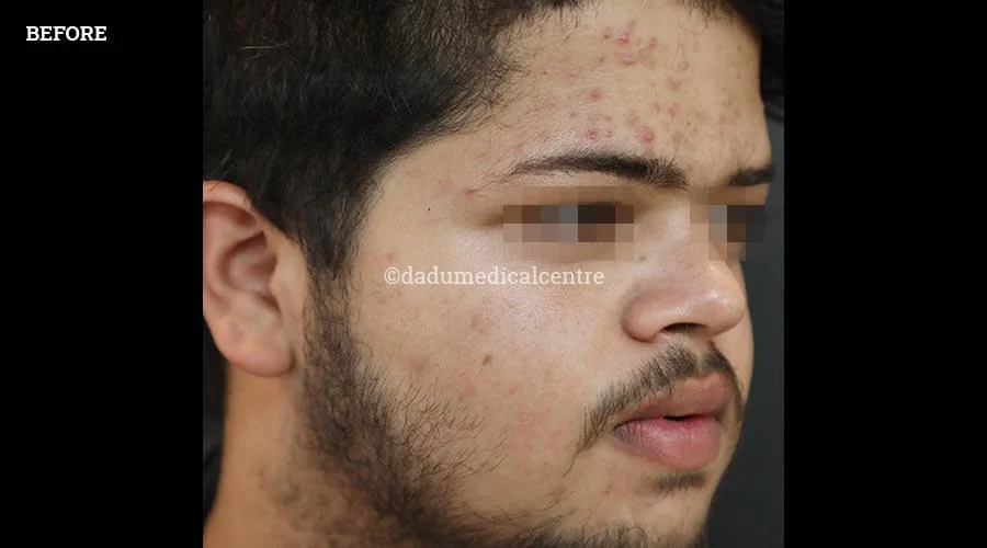 DMC-Acne Check Peel - before