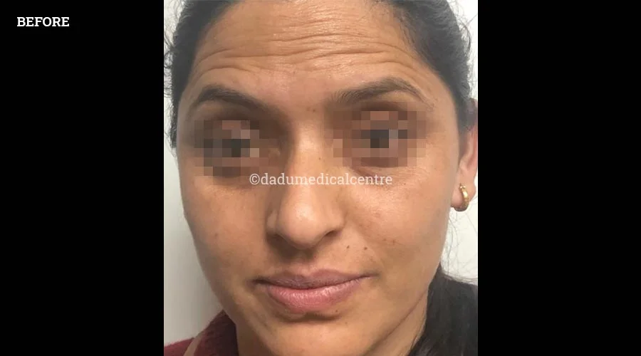 Anti-Wrinkle Injection - before