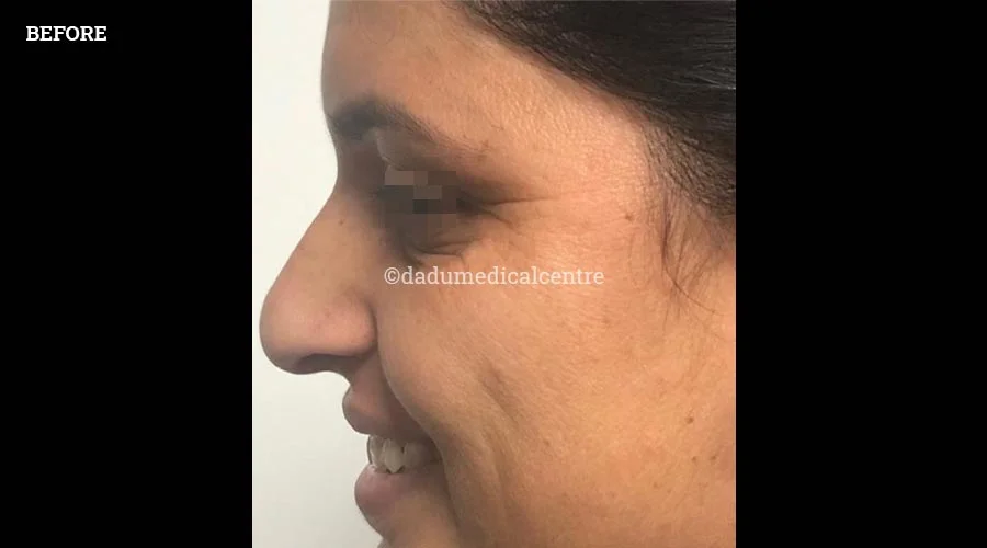 Anti-Wrinkle Injection - before
