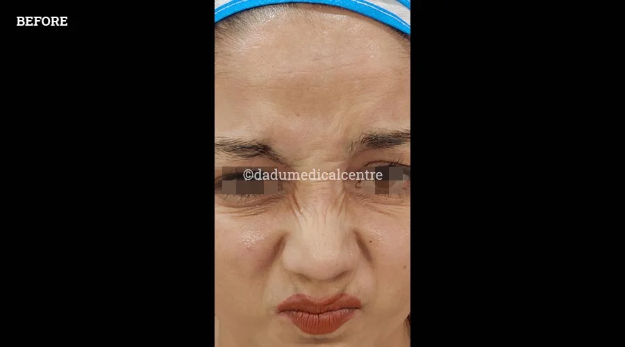 Forehead Lift - before