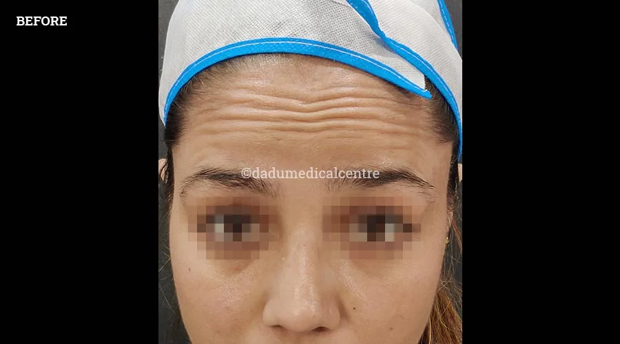 Forehead Lift - before