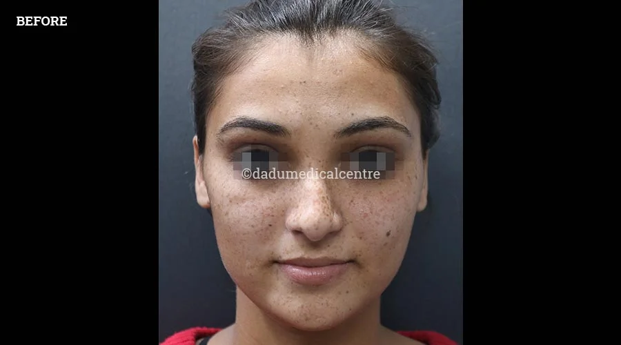 Freckles - before