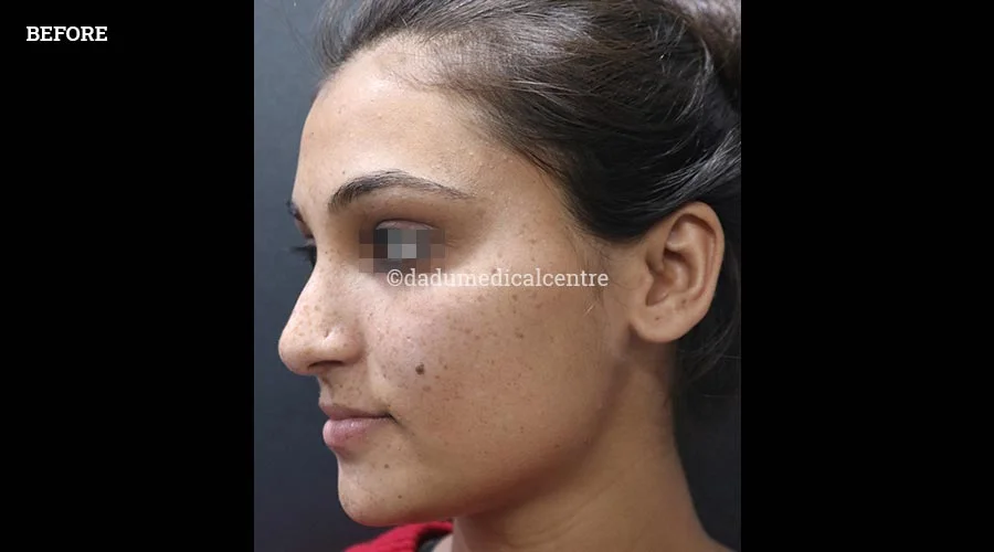 Freckles - before