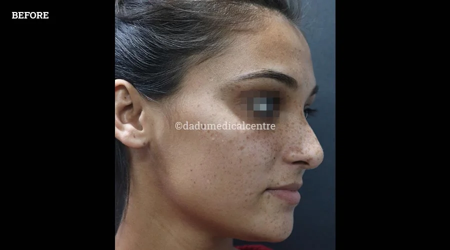 Freckles - before