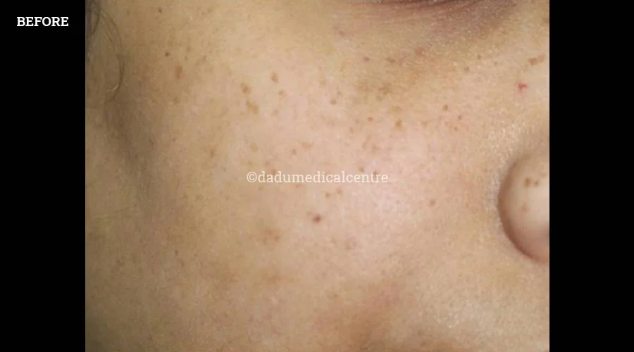 Freckles - before