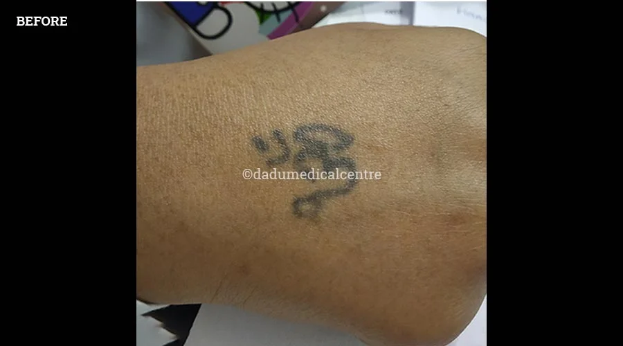 Laser Tattoo Removal - before