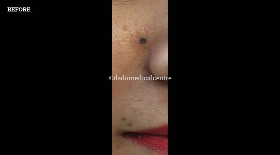Mole Removal - before