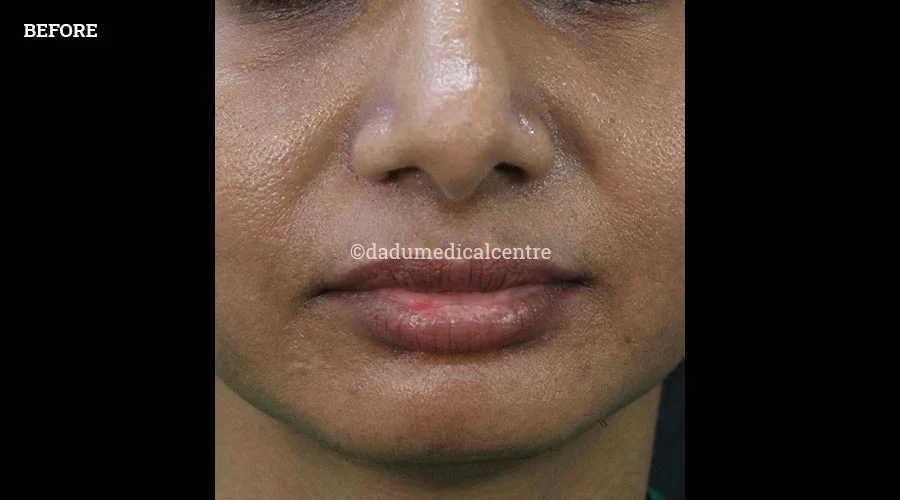 Nasolabial Folds - before