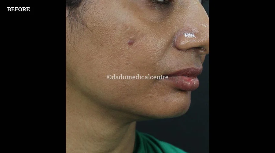 Nasolabial Folds - before