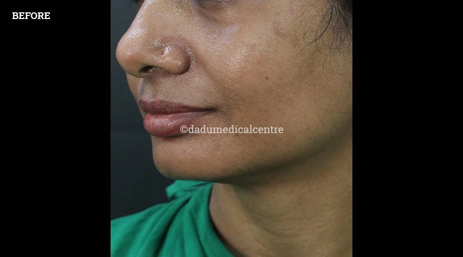 Nasolabial Folds - before