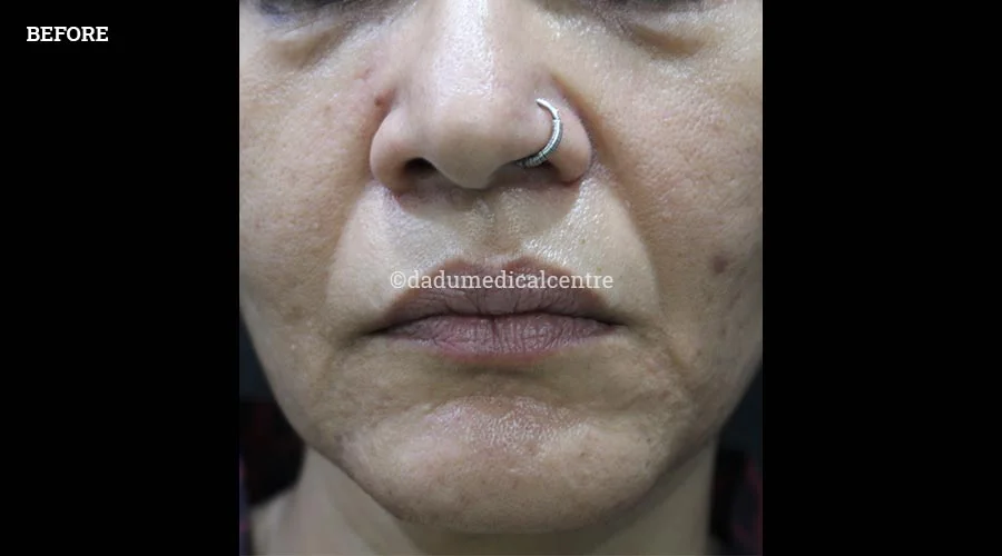 Nasolabial Folds - before