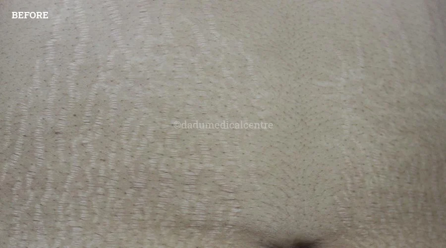Stretch Marks - before