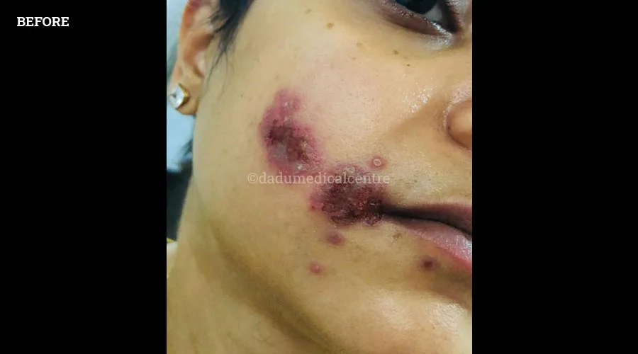 Urticaria - before