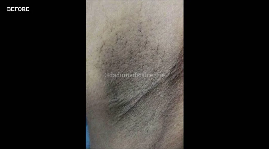 Under Arms - before